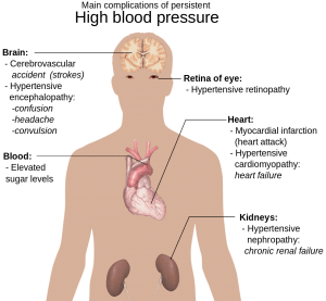 Image showing complications of hypertension 