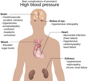 Image showing complications of hypertension